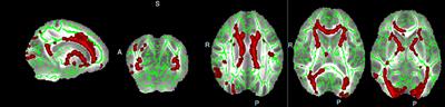 Reduced White Matter Integrity With Cognitive Impairments in End Stage Renal Disease